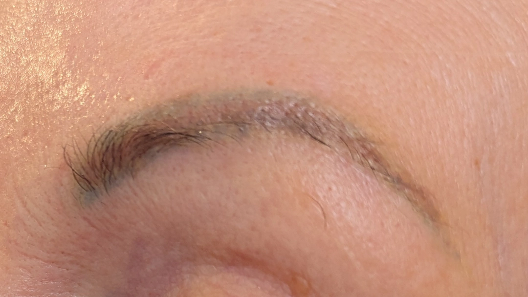 Tatueringsborttagning