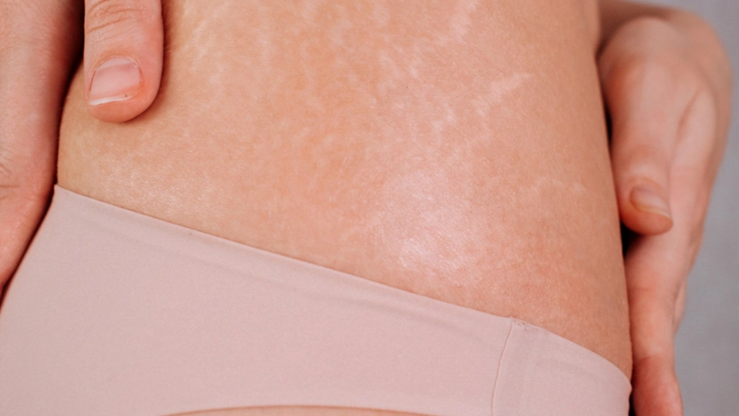 Bristningar och ärr